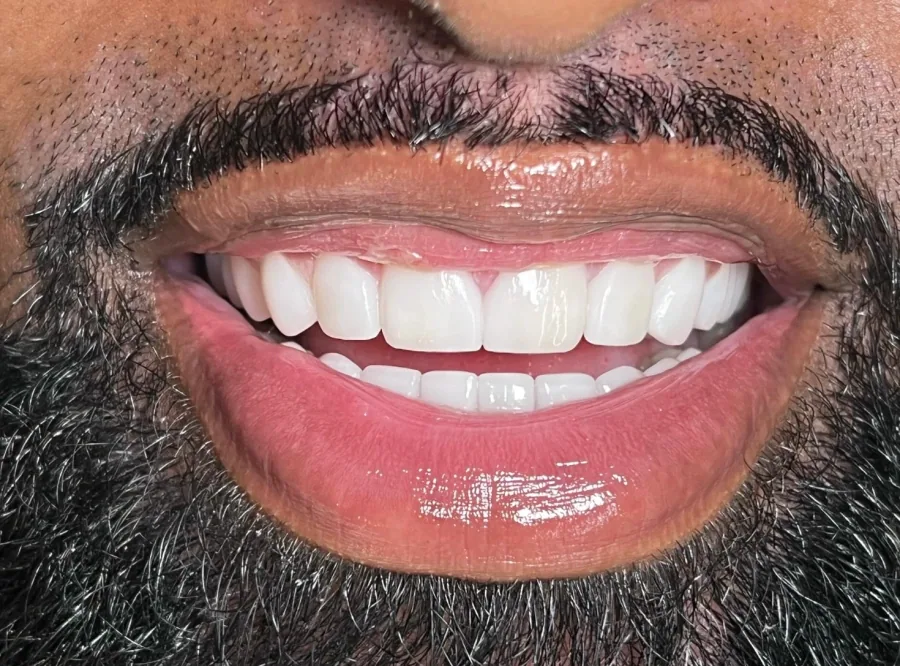 Bright smile rehabilitation After