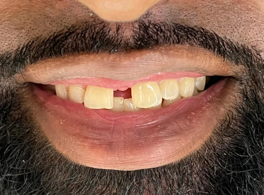 Bright smile rehabilitation Before