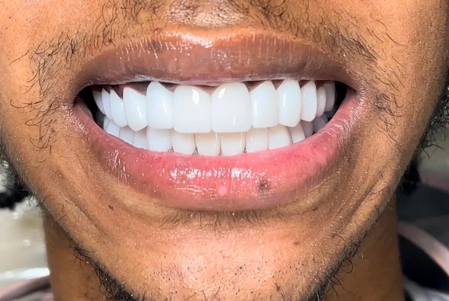 Comprehensive smile rehabilitation After