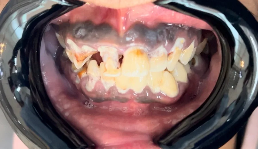 Comprehensive smile rehabilitation Before