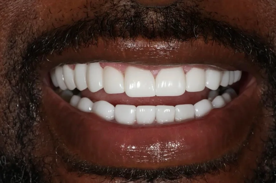 Complex restorative smile after