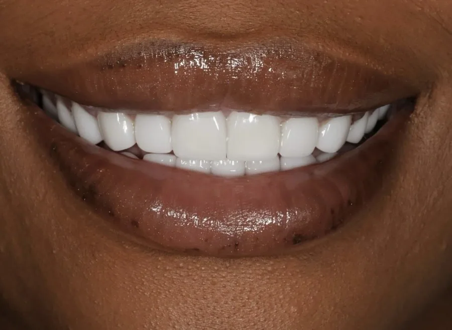 Natural smile brightening After