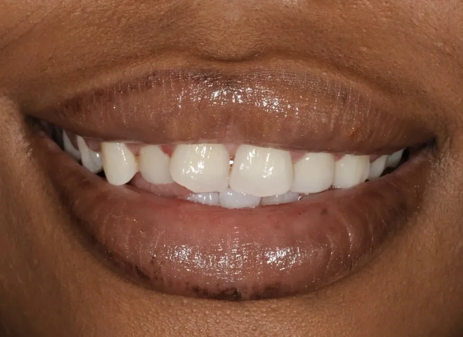 Natural smile brightening Before