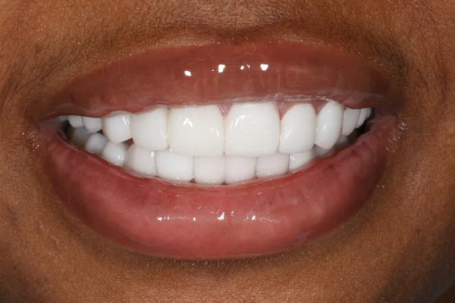 Orthodontic and aesthetic planning After