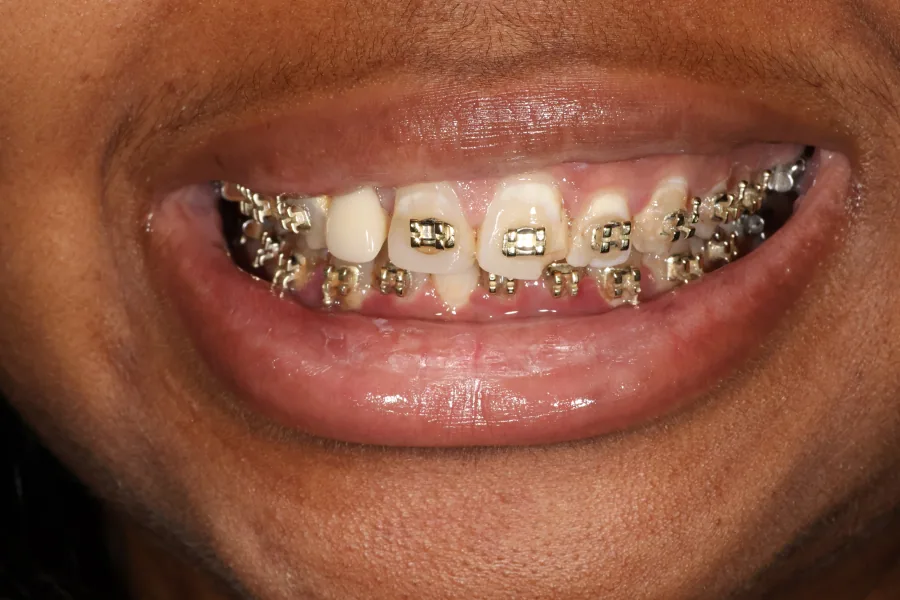 Orthodontic and aesthetic planning Before