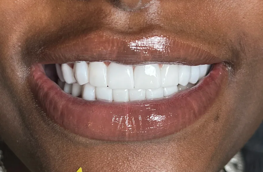 Full-smile restorative planning After