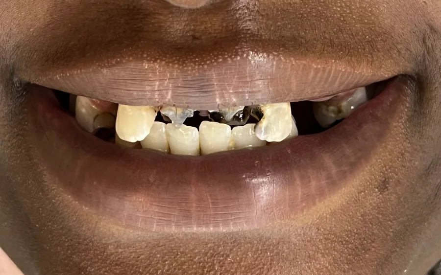Full-smile restorative planning Before
